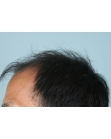 Before Hair Transplant&nbsp;2 Sessions (Areas)